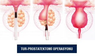 Prostat İyi Huylu Büyümesi (BPH)